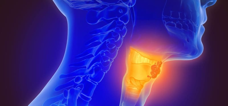 Unmasking the Hidden Threat: HPV-Related Oropharyngeal Cancer on the Rise post image